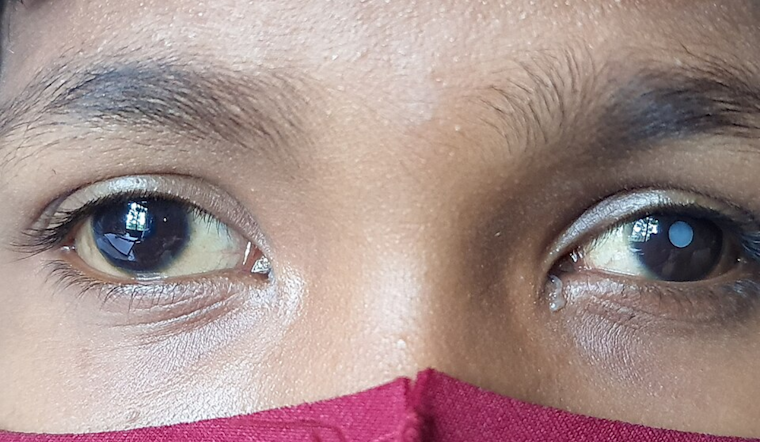 University of Cincinnati Study Reveals Fear as Barrier to Cataract Surgery Among Patients