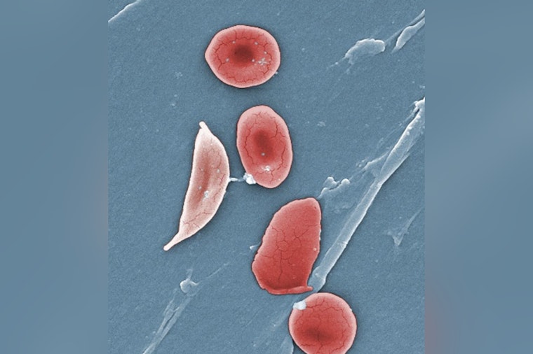 Jersey Teen and New Yorker Triumph Over Sickle Cell With Pioneering Gene Therapy