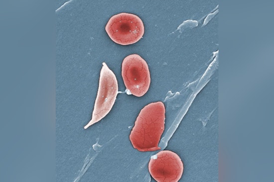 Jersey Teen and New Yorker Triumph Over Sickle Cell With Pioneering Gene Therapy
