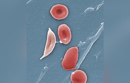 Jersey Teen and New Yorker Triumph Over Sickle Cell With Pioneering Gene Therapy