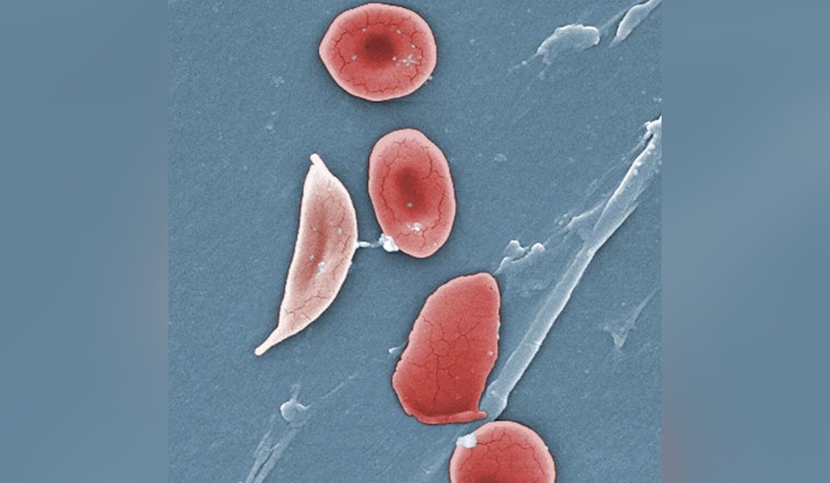 Jersey Teen and New Yorker Triumph Over Sickle Cell With Pioneering Gene Therapy