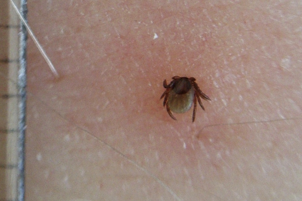 Lyme Disease Cases Surge by 168% in Michigan, Health Officials Urge Caution Amid Rising Tick-Borne Illnesses