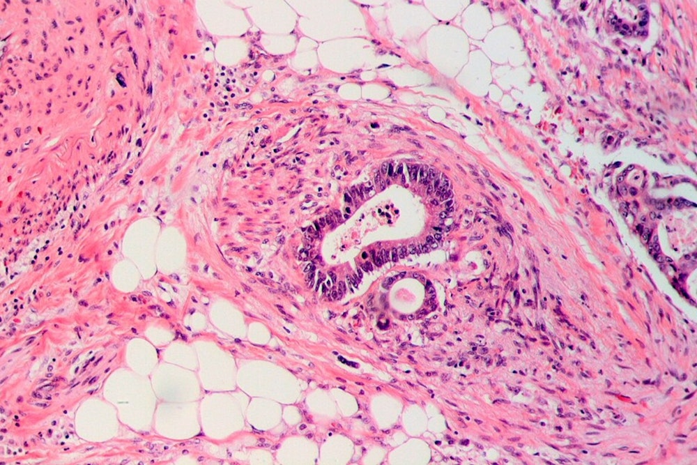 Ohio Scientists Forge Cancer-Fighting Sword with AI: Revolutionary PANDA Platform Promises Noninvasive Colorectal Screening Breakthrough