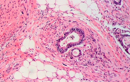Ohio Scientists Forge Cancer-Fighting Sword with AI: Revolutionary PANDA Platform Promises Noninvasive Colorectal Screening Breakthrough