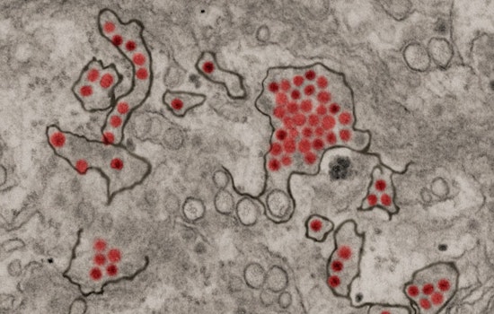 Ohio State University Study Reveals How Zika Virus Evades Human Immune Response to Spread Efficiently