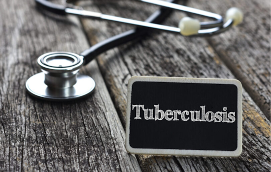 Public Health Alert: Potential TB Exposure at St. Michael's Catholic Church in San Diego