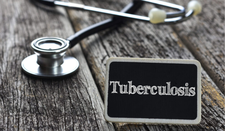 Public Health Alert: Potential TB Exposure at St. Michael's Catholic Church in San Diego