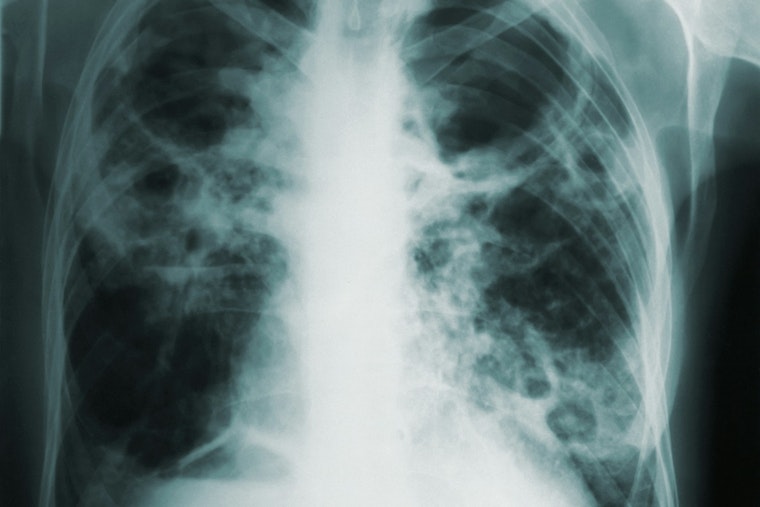 Tuberculosis Concerns Rise in Florida with Cases at Miami Detention Center and Fort Lauderdale High School