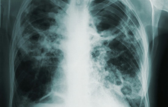Tuberculosis Concerns Rise in Florida with Cases at Miami Detention Center and Fort Lauderdale High School