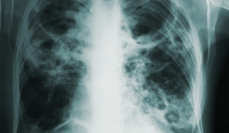 Tuberculosis Concerns Rise in Florida with Cases at Miami Detention Center and Fort Lauderdale High School