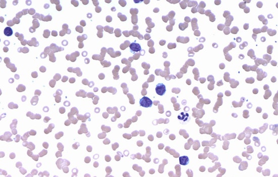 University of Cincinnati Cancer Center Unveils MYC's Role in Driving Lymphoma, Paving Way for Targeted Treatments