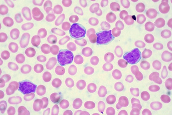 Cincinnati Breakthrough: Novel Drug 'Bexobrutideg' Stuns with Success in CLL Battle