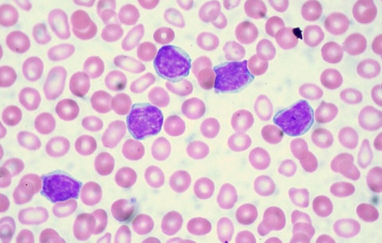 Cincinnati Breakthrough: Novel Drug 'Bexobrutideg' Stuns with Success in CLL Battle