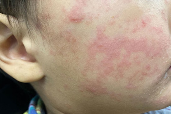 Measles Outbreak in Navajo County, Arizona with Four Unvaccinated Individuals After International Travel Exposure