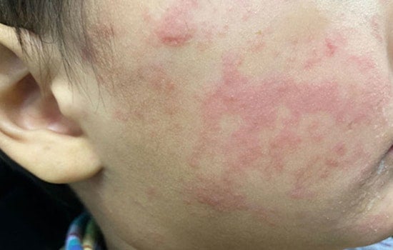 Measles Outbreak in Navajo County, Arizona with Four Unvaccinated Individuals After International Travel Exposure