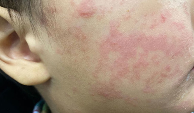 New Measles Case in L.A. County, Santa Clarita Shoppers Warned of Exposure at Costco, Trader Joe's, and Walmart