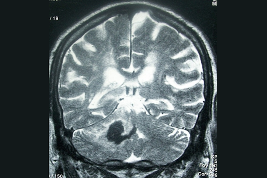 University of Cincinnati Expert Dr. Yasmin Aziz Advocates for Research on Outpatient Management of Hemorrhagic Stroke