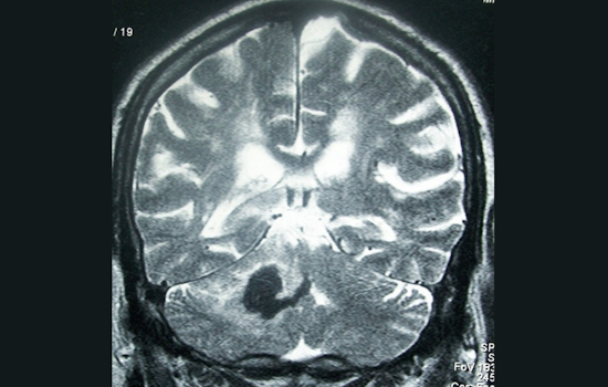 University of Cincinnati Expert Dr. Yasmin Aziz Advocates for Research on Outpatient Management of Hemorrhagic Stroke