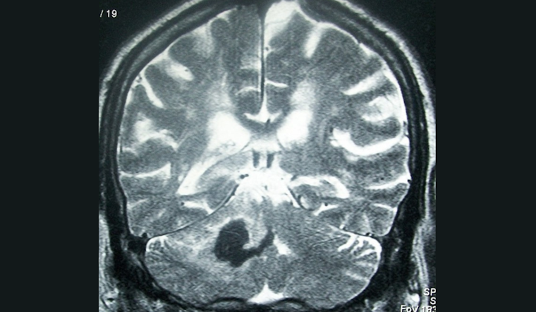 University of Cincinnati Expert Dr. Yasmin Aziz Advocates for Research on Outpatient Management of Hemorrhagic Stroke