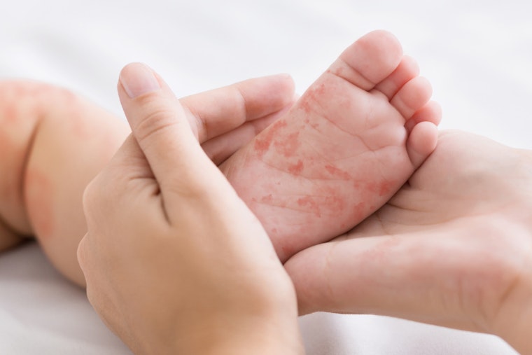 Arizona's Navajo County Reports Cases of Measles, Coconino County on High Alert