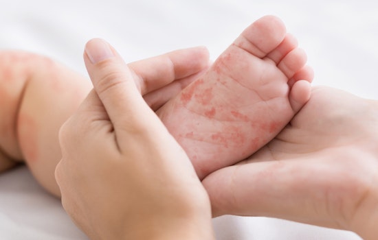 Arizona's Navajo County Reports Cases of Measles, Coconino County on High Alert