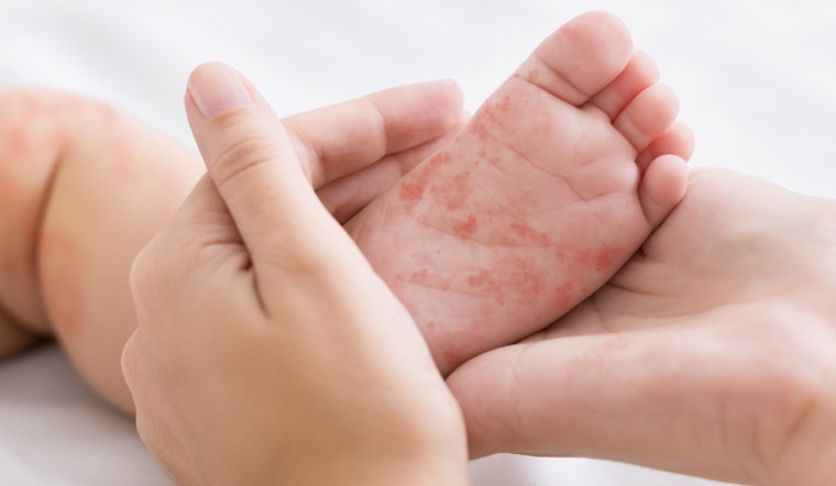 Arizona's Navajo County Reports Cases of Measles, Coconino County on High Alert