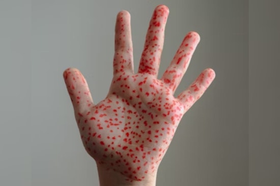 El Paso Ramps Up Measles Defense with Free Vaccines and Extended Clinic Hours