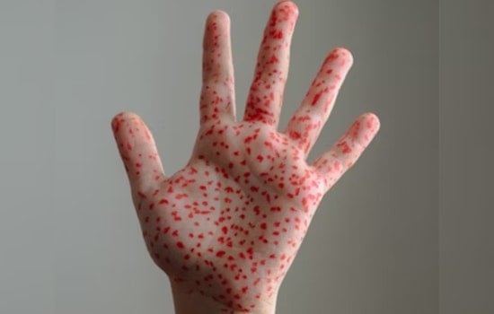 El Paso Ramps Up Measles Defense with Free Vaccines and Extended Clinic Hours