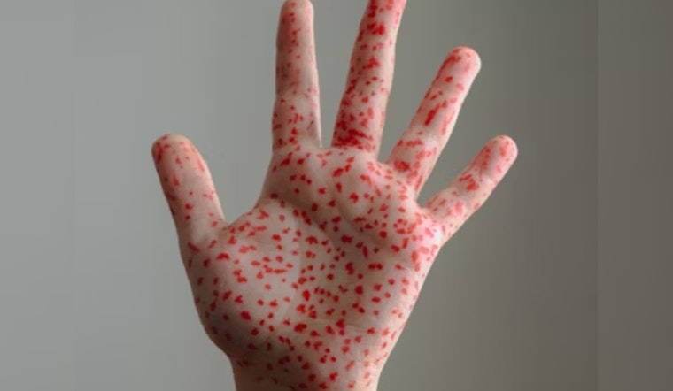 El Paso Ramps Up Measles Defense with Free Vaccines and Extended Clinic Hours