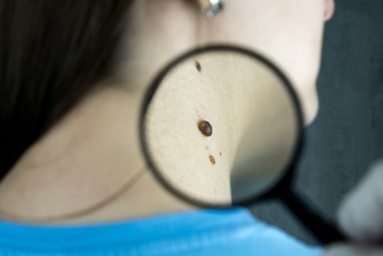 Mount Sinai's Vectra WB180 Advances Skin Cancer Detection, Brisbane Study Supports 3D Imaging's Efficacy
