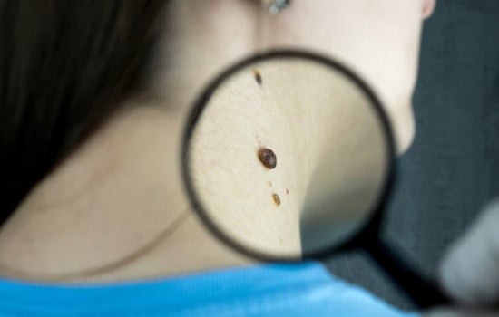 Mount Sinai's Vectra WB180 Advances Skin Cancer Detection, Brisbane Study Supports 3D Imaging's Efficacy