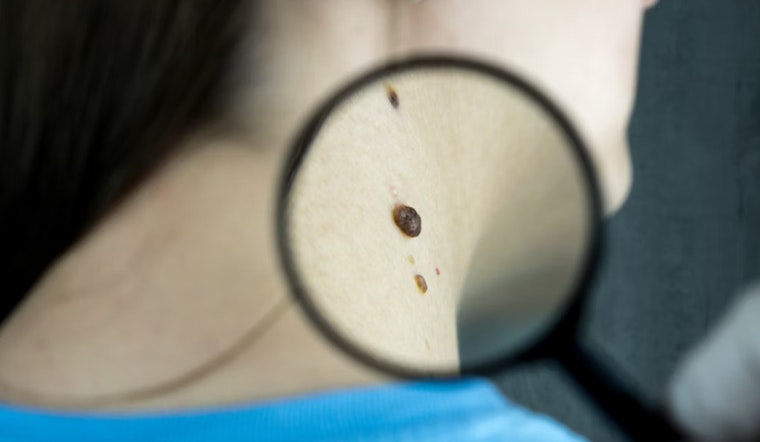 Mount Sinai's Vectra WB180 Advances Skin Cancer Detection, Brisbane Study Supports 3D Imaging's Efficacy