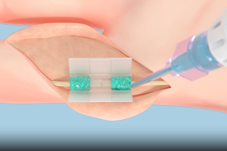FDA Greenlights Tissium's Revolutionary Suture-Free Surgery Tech Developed at MIT