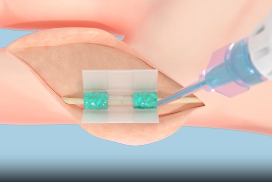FDA Greenlights Tissium's Revolutionary Suture-Free Surgery Tech Developed at MIT