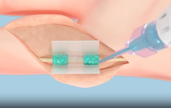 FDA Greenlights Tissium's Revolutionary Suture-Free Surgery Tech Developed at MIT