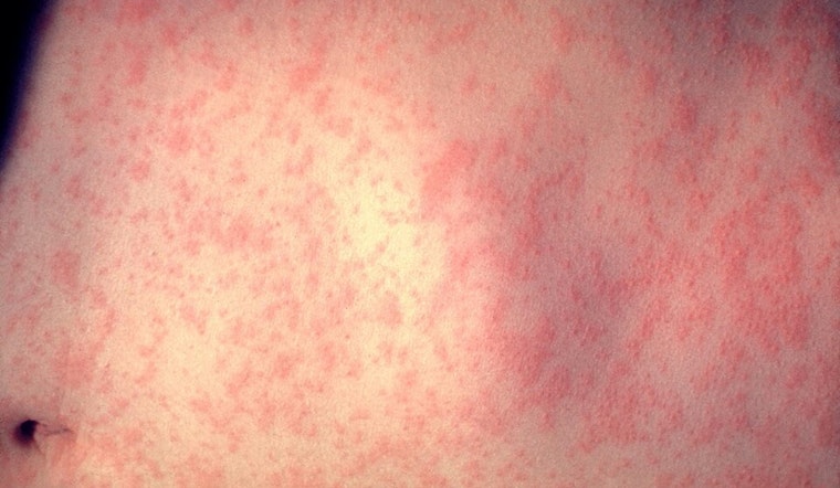 Measles Case in Out-of-State Visitor Prompts Health Alert Near Monarch Pass, Colorado