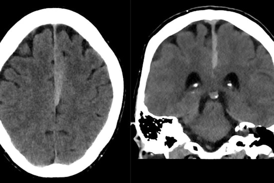 University of Cincinnati Launches Pioneering Study on Subdural Hematoma Outcomes and Blood-Thinner Use