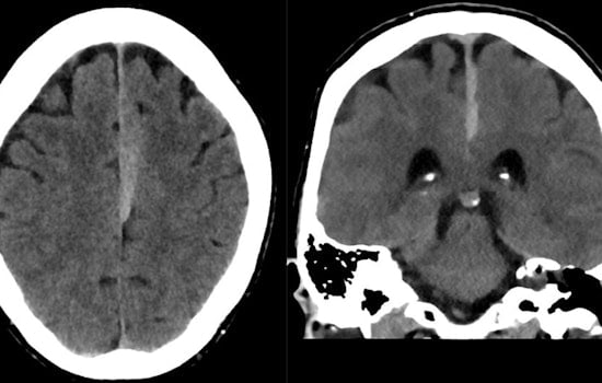 University of Cincinnati Launches Pioneering Study on Subdural Hematoma Outcomes and Blood-Thinner Use