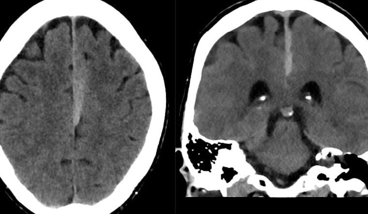 University of Cincinnati Launches Pioneering Study on Subdural Hematoma Outcomes and Blood-Thinner Use