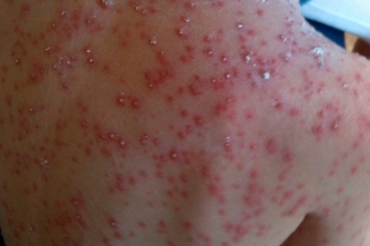 Confirmed Case of Chickenpox in Rowan County Prompts Health Alert and Calls for Vaccination