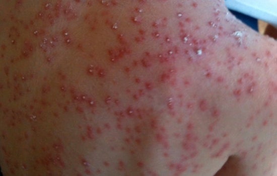 Confirmed Case of Chickenpox in Rowan County Prompts Health Alert and Calls for Vaccination