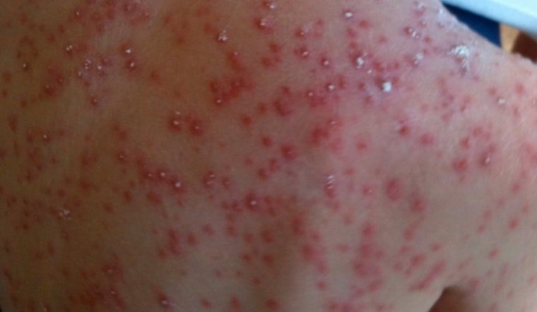Confirmed Case of Chickenpox in Rowan County Prompts Health Alert and Calls for Vaccination