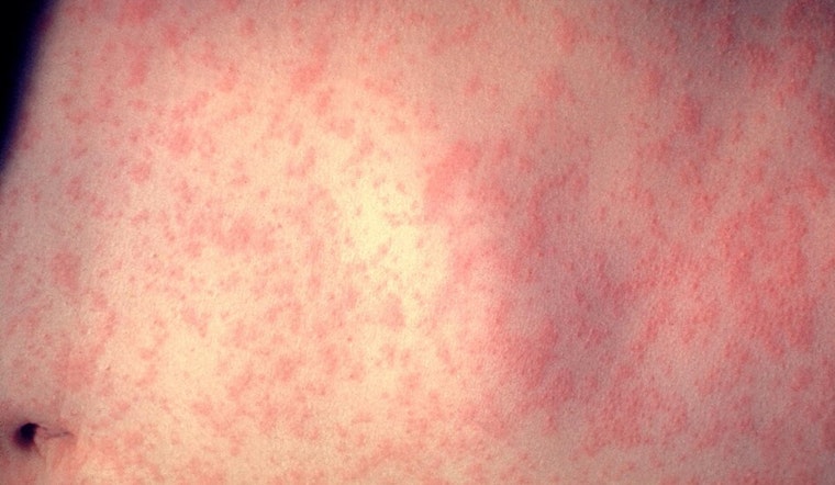 First Measles Case Confirmed in Grand County in Unvaccinated Minor, Health Officials Recommend Vaccination to Prevent Spread