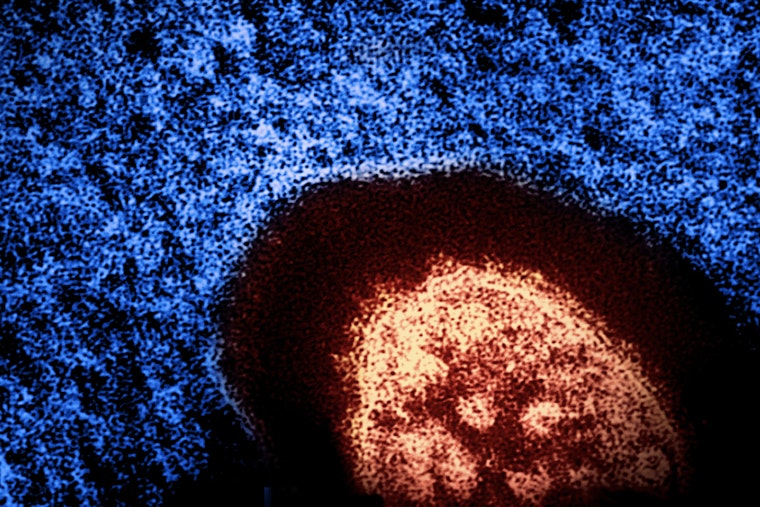 Health Alert for Potential Measles Exposure on Manhattan's Lower East Side and SoHo