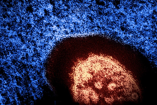 Health Alert for Potential Measles Exposure on Manhattan's Lower East Side and SoHo