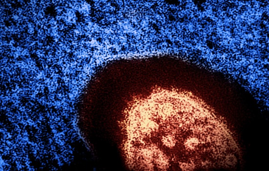 Health Alert for Potential Measles Exposure on Manhattan's Lower East Side and SoHo