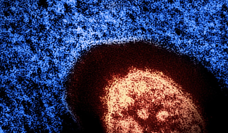 Health Alert for Potential Measles Exposure on Manhattan's Lower East Side and SoHo