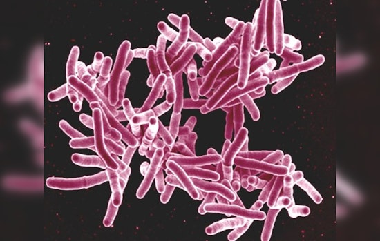 Tuberculosis Case at Indio High School Spurs Public Health Response in Riverside County