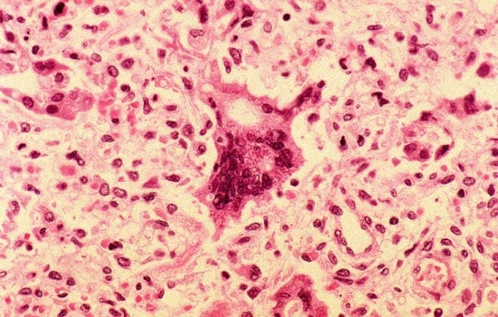 Confirmed Measles Case at Ridgefield High Raises Alert for Unvaccinated Individuals