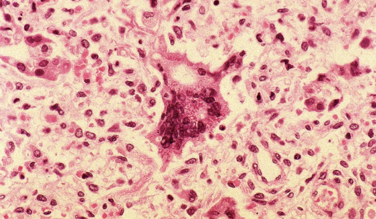 Confirmed Measles Case at Ridgefield High Raises Alert for Unvaccinated Individuals